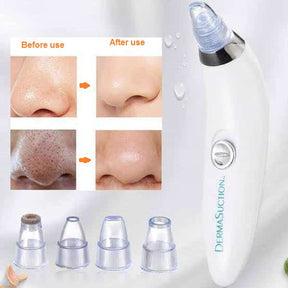 Derma Suction Acne Blackhead Remover Vacuum